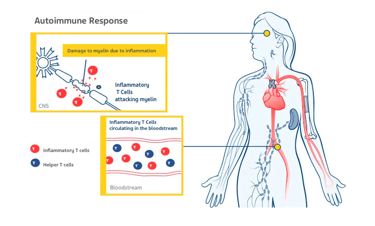 A diagram about the autoimmune response to multiple sclerosis.